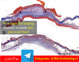 درمان قطعی زخم پای دیابتی | داروی گیاهی برای زخم های دیابتی | درمان گیاهی زخم پای دیابتی | درمان انتی بیوتیکی زخم پای دیابتی | درمان زخم پای دیابتی با عسل | پماد برای زخم پای دیابتی | درمان زخم پای دیابتی با زالو | انواع زخم پای دیابتی