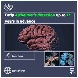 تشخیص زود هنگام آلزایمر 17 سال قبل از رخ دادن آن
